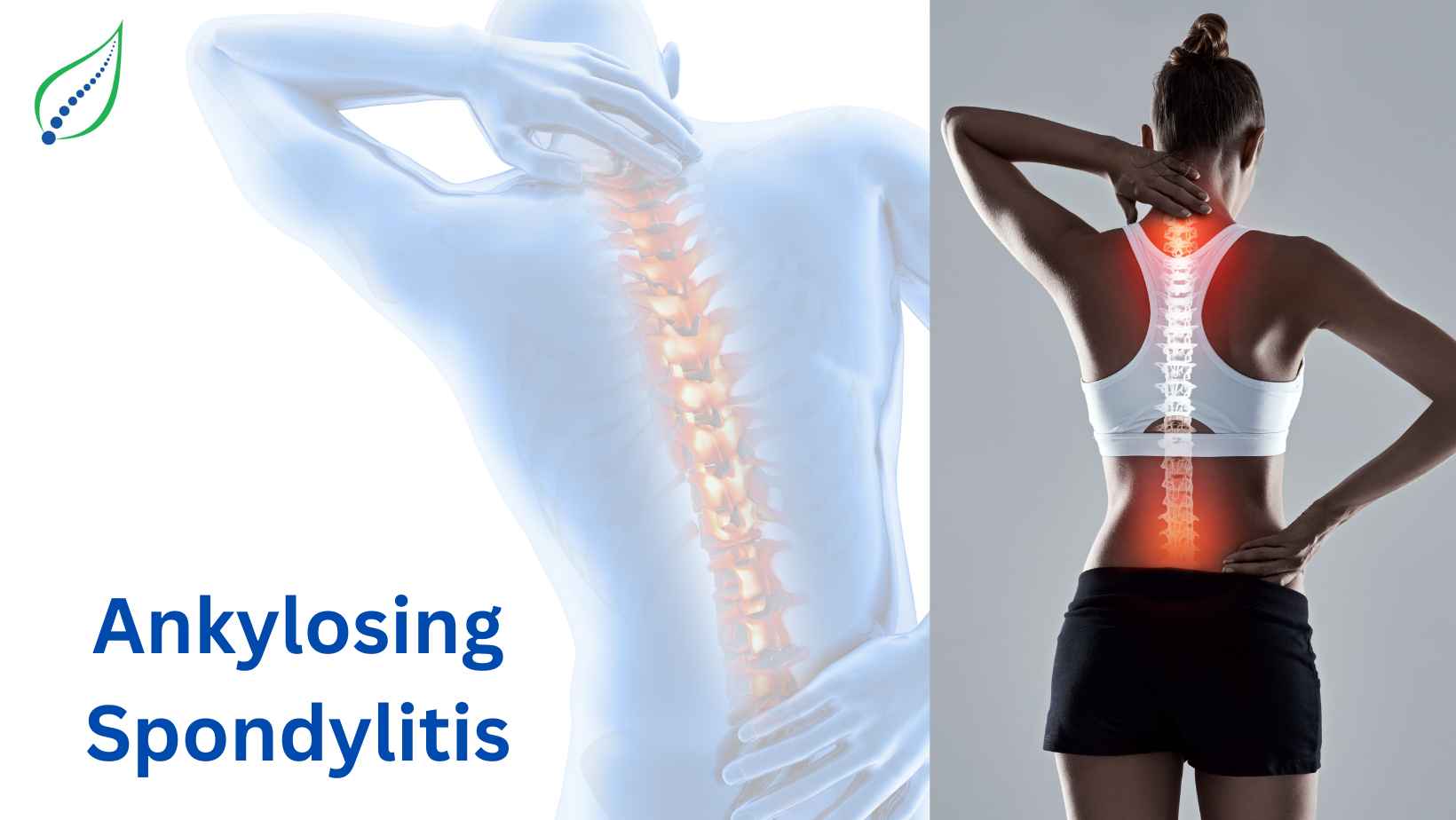 Ankylosing Spondylitis